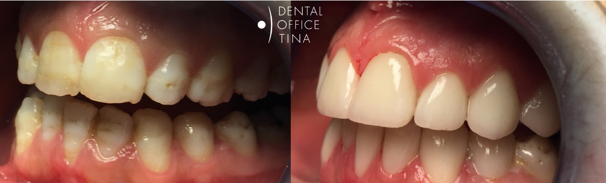 tetraciklinski zubi dental office tina