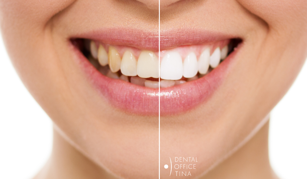 izbjeljivanje zubi prije i poslije