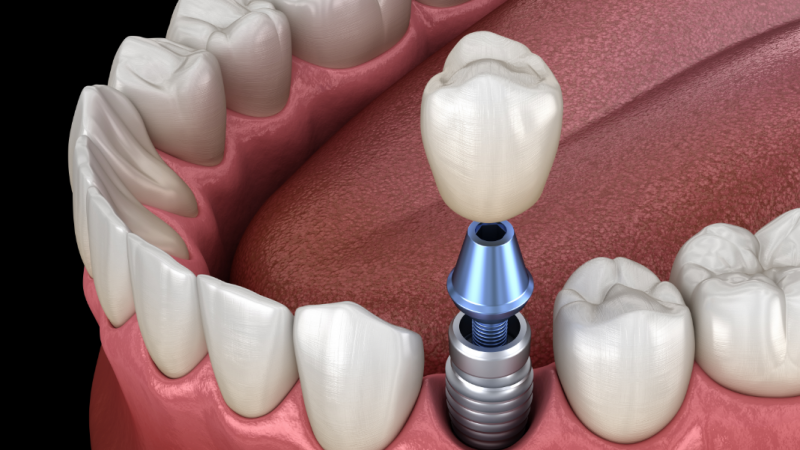 prednosti implantata