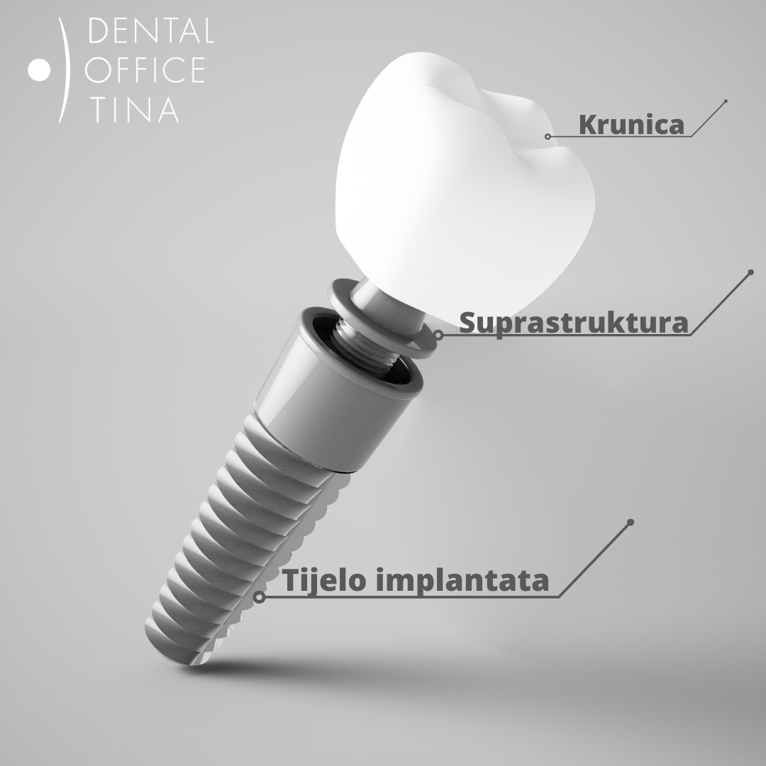 od čega se sastoji zubni implantat